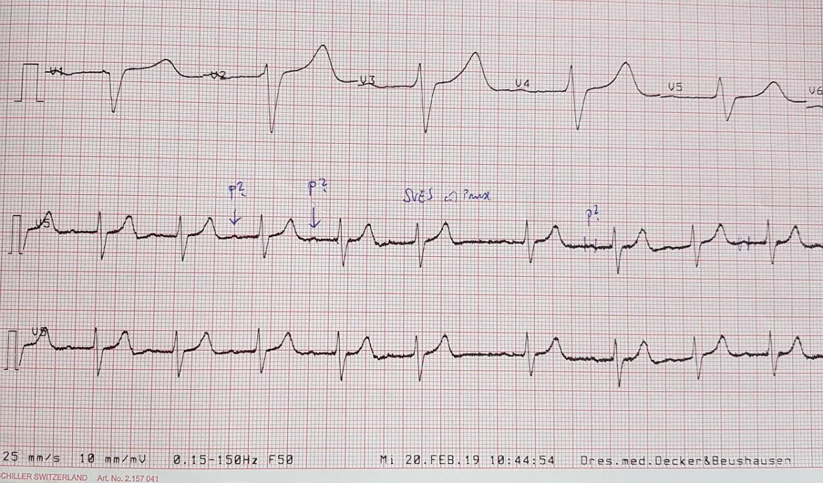 Traçado de eletrocardiograma impresso em papel